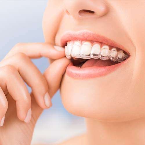 Invisalign – Orthoi