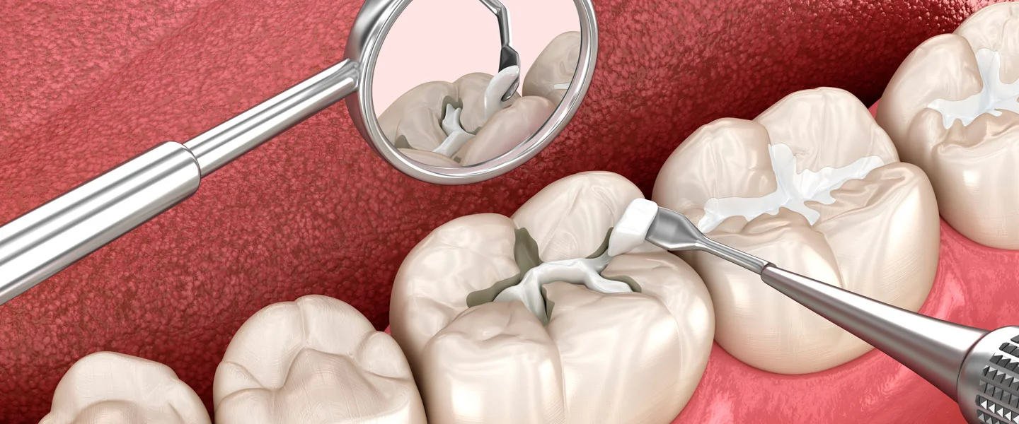 Fissure Sealant