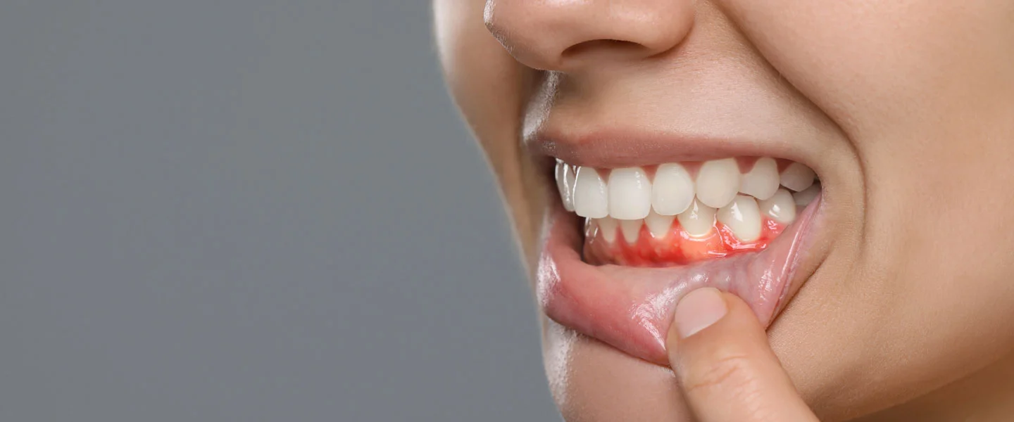 Gum Health