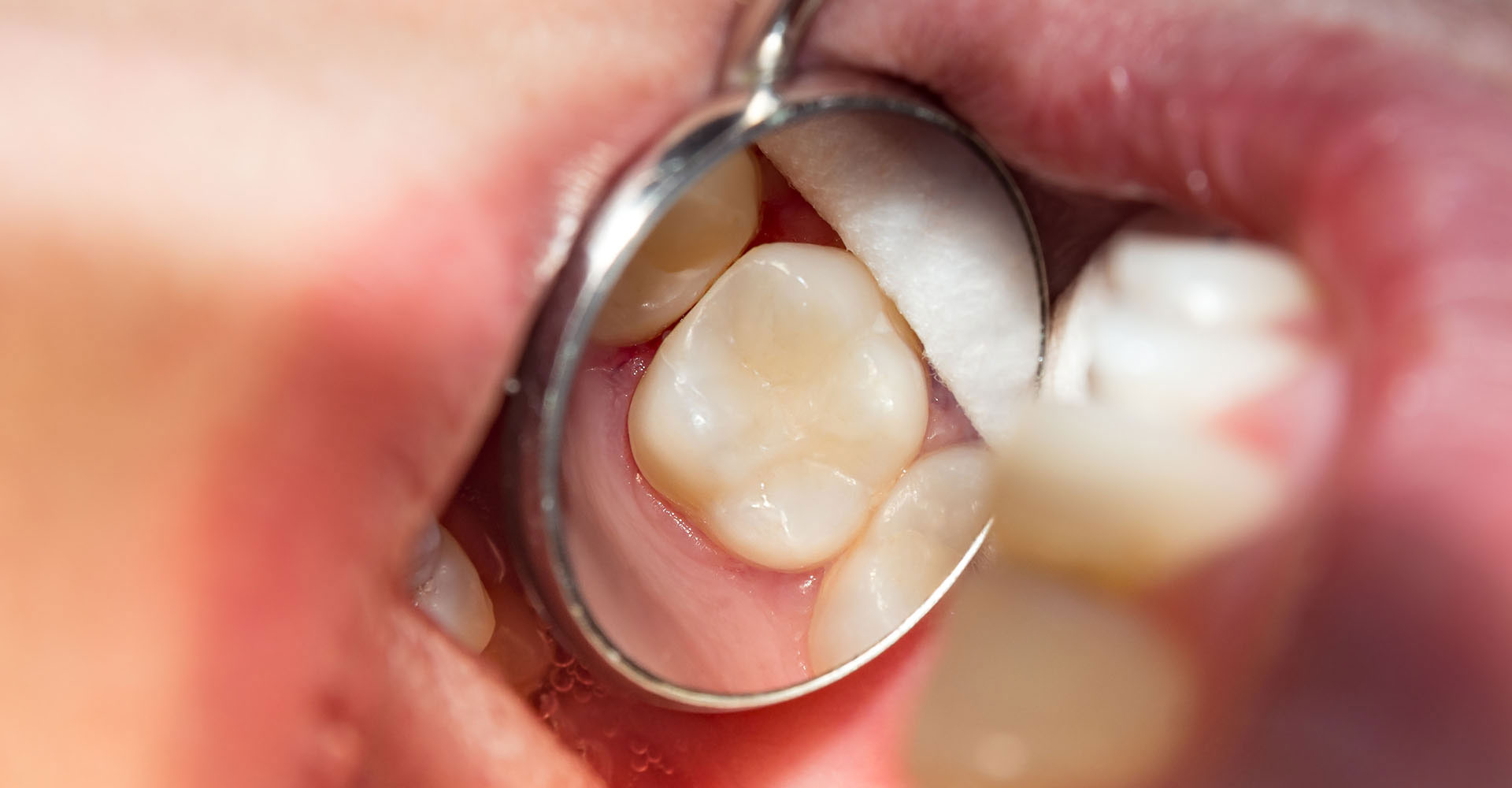 Dental Emergency