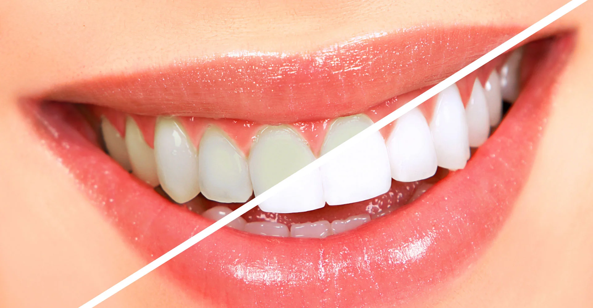 Teeth Whitening