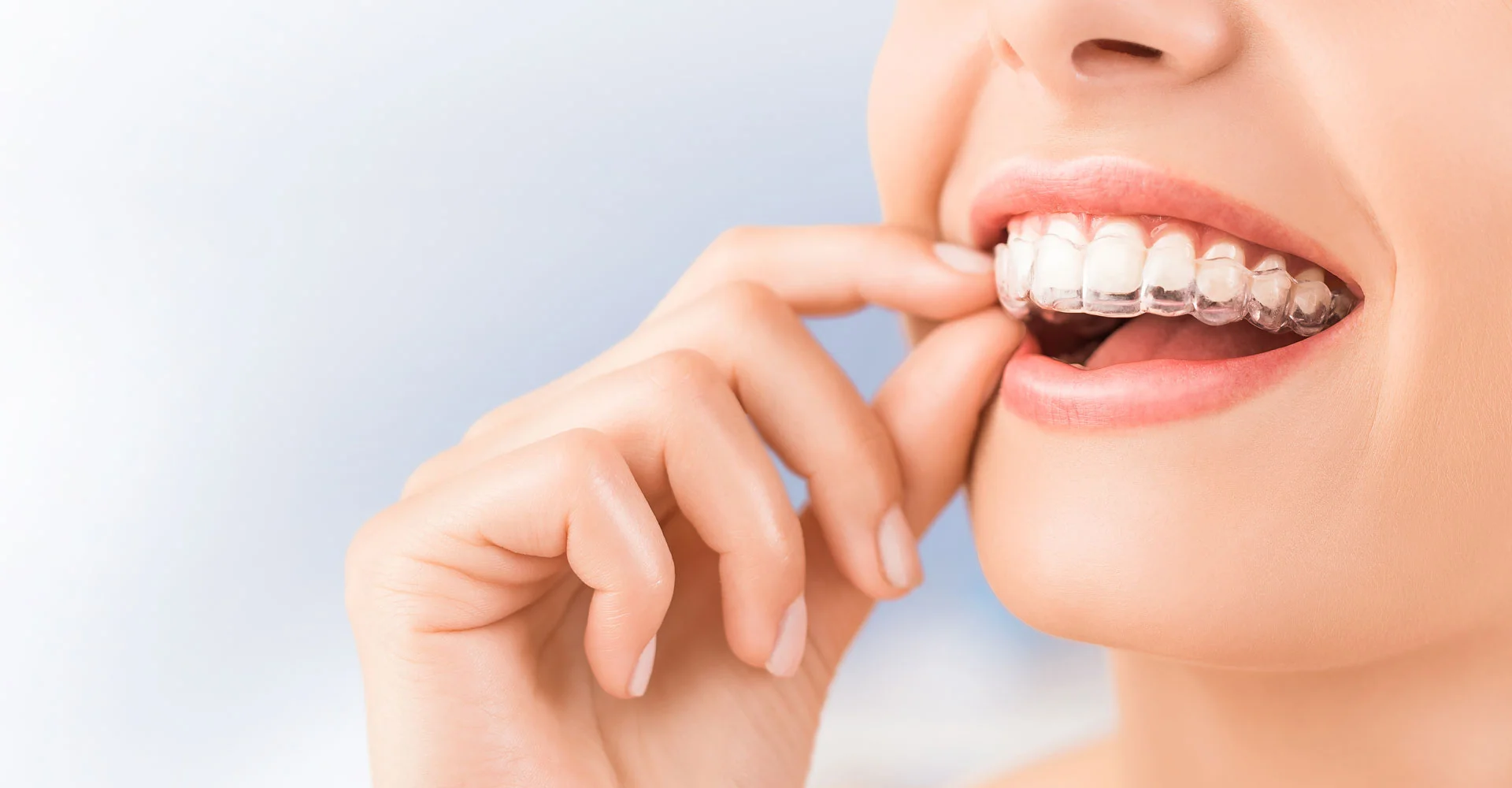 Invisalign