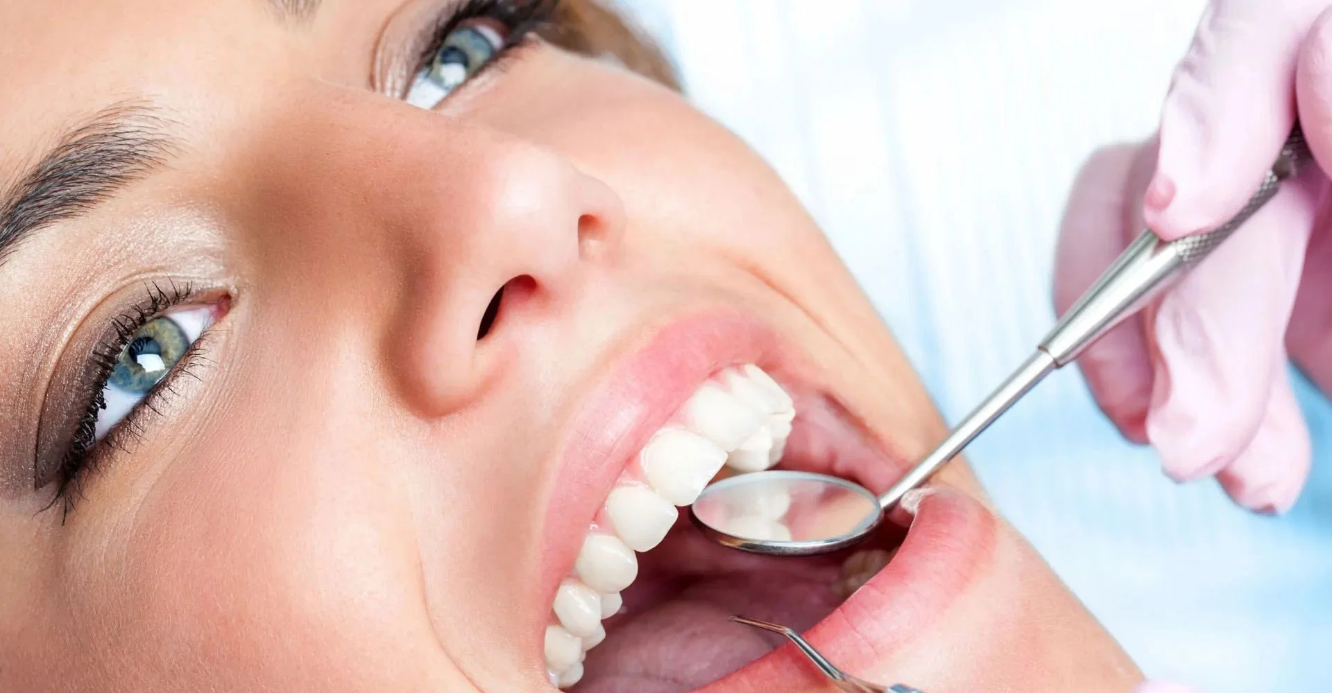 White Composite Fillings