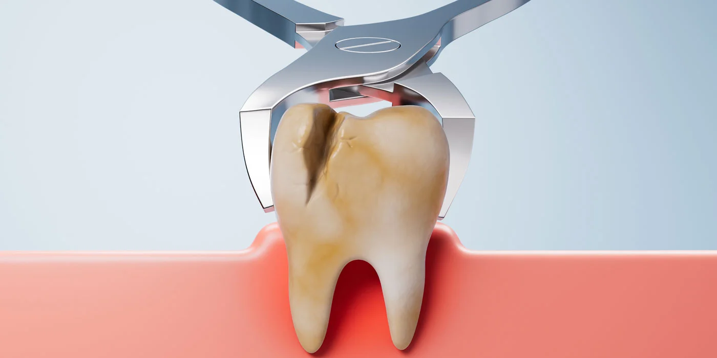Dental Pain
